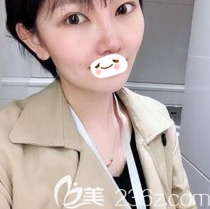 做肋软骨隆鼻+美杜莎内眼角术后半个月