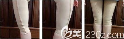 上海艺星医疗美容医院李建兵大腿吸脂真人案例术后十八天