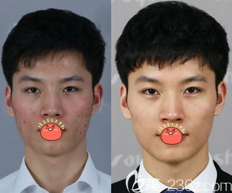 永康光大刘瑞O4元素破茧疗法祛痘案例