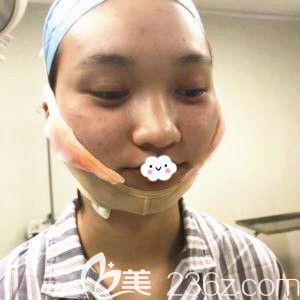 武汉华美整形医院付国友去下颌角术后7天效果