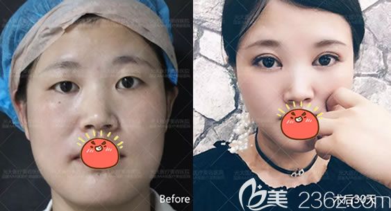 在永康光大做双眼皮开眼角对比图 在永康光大做双眼皮开眼角对比图