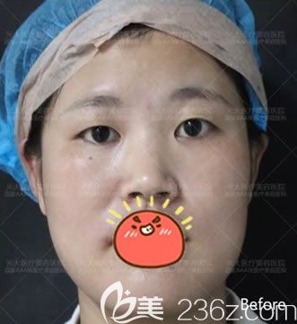 在永康光大做双眼皮前照片 在永康光大做双眼皮前照片