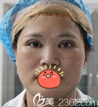 永康光大医院刚做完双眼皮照片 永康光大医院刚做完双眼皮照片