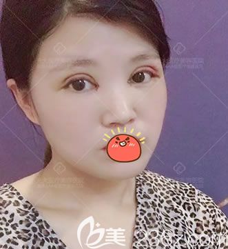 在永康光大做双眼皮开眼角3天后 在永康光大做双眼皮开眼角3天后