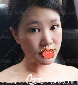 做完双眼皮开眼角15天恢复照 做完双眼皮开眼角15天恢复照