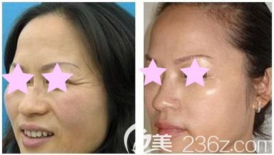 玉林时光整形李红梅医生面部除皱案例 玉林时光整形李红梅医生面部除皱案例