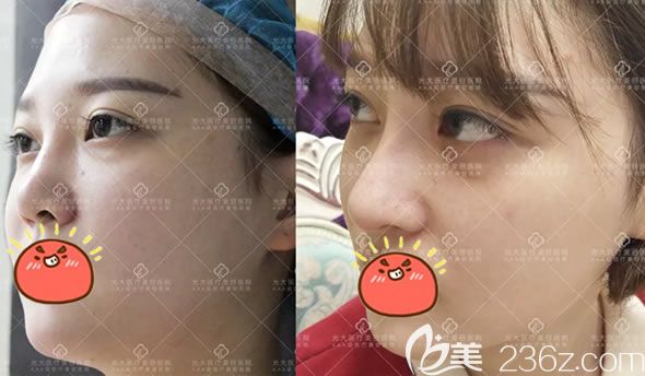 永康光大整形超体鼻综合隆鼻案例 永康光大整形超体鼻综合隆鼻案例