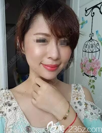 趁着伊婉玻尿酸有优惠价格到南通康美填充改善法令纹凹陷泪沟还顺带给下巴也注射了一支