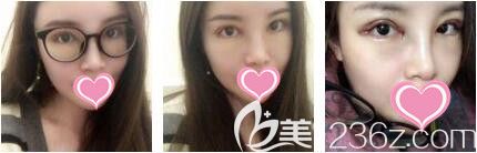 上海艺星医疗美容医院李勇眼修复真人案例术后第三天