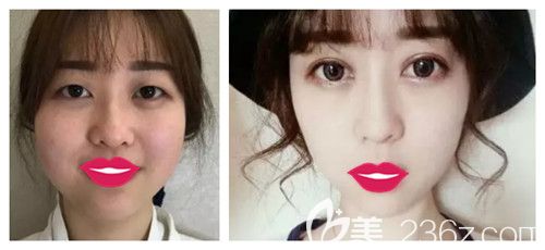 邯郸金煌后2019整形优惠狂欢购 双眼皮和只需750元