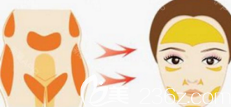 脂肪移植示意图