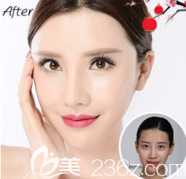 面部脂肪移植案例