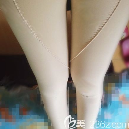 我在南宁华美做大腿吸脂术后第3天的照片