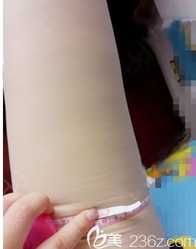 我在南宁华美整形做吸脂后第7天照片