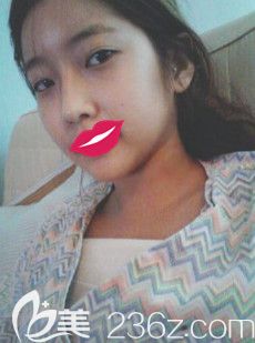 在秦皇岛念奴娇刚做完隆胸术后有点肿胀