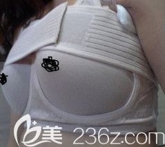 刘云涛院长为我做假体隆胸7天后坚持穿塑胸衣