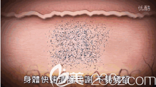 清除黑色素效率高 清除黑色素效率高