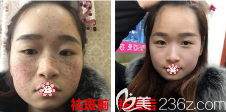 重庆艺星整形皮秒祛雀斑案例 重庆艺星整形皮秒祛雀斑案例