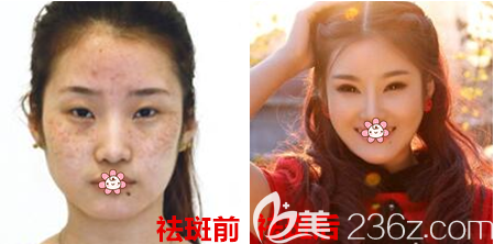 重庆艺星整形皮秒祛斑效果怎么样 重庆艺星整形皮秒祛斑效果怎么样