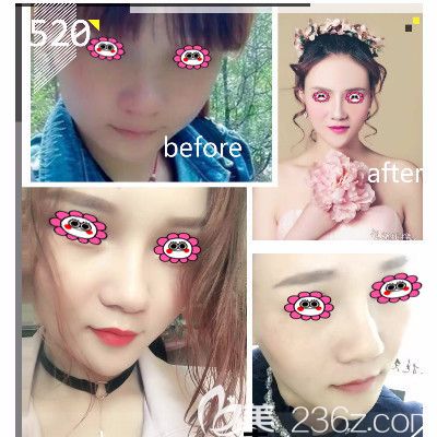 隆鼻效果图 隆鼻效果图