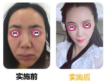 瘦脸变化图 瘦脸变化图