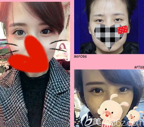 杨明锋医生双眼皮前后对比图 杨明锋医生双眼皮前后对比图