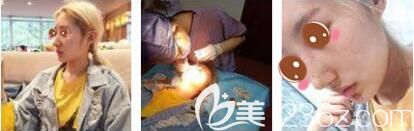 上海艺星医疗美容医院彭才学驼峰鼻矫正真人案例术后第七天