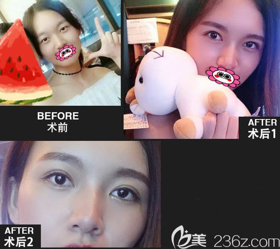 厦门脸博士林建新双眼皮效果图 厦门脸博士林建新双眼皮效果图