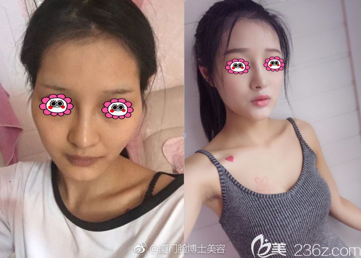 厦门脸博士医生唐毅面部脂肪填充对比图 厦门脸博士医生唐毅面部脂肪填充对比图