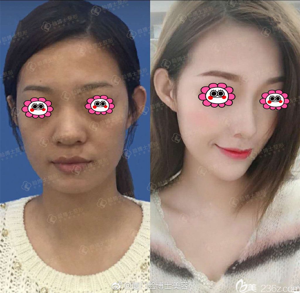 厦门脸博士整形贾洪仁隆鼻变化图 厦门脸博士整形贾洪仁隆鼻变化图