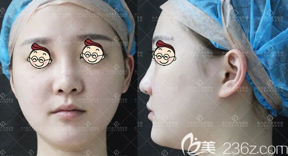 在永康光大医院做鼻子之前 在永康光大医院做鼻子之前