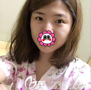 在北京画美做双眼皮修复前样子 在北京画美做双眼皮修复前样子