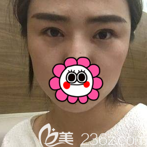 北京画美双眼皮修复<span style= 北京画美双眼皮修复<span style=