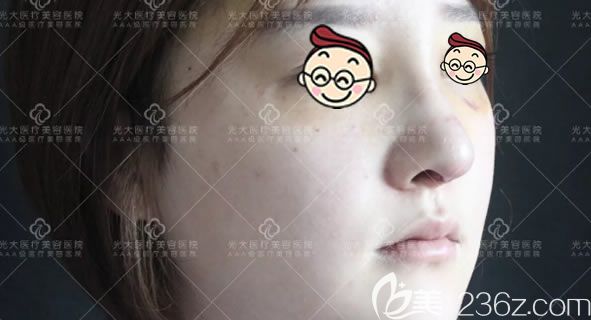 做完鼻综合隆鼻7天恢复照 做完鼻综合隆鼻7天恢复照