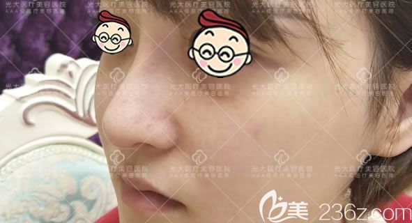 做完膨体和软骨鼻综合30天后 做完膨体和软骨鼻综合30天后