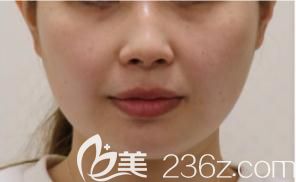 高泽博和面部吸脂前正面 高泽博和面部吸脂前正面