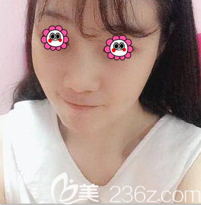 北京京民整形医院自体脂肪面部填充+鼻综合隆鼻案例