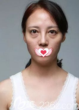 在秦皇岛巧致做脂肪填充面部前面部干瘪显老 在秦皇岛巧致做脂肪填充面部前面部干瘪显老