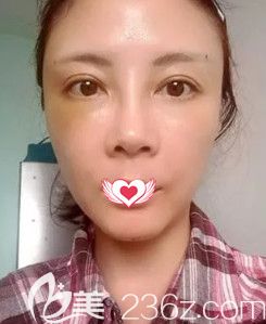 王立英院长为我做完脂肪填充面部后微肿 王立英院长为我做完脂肪填充面部后微肿