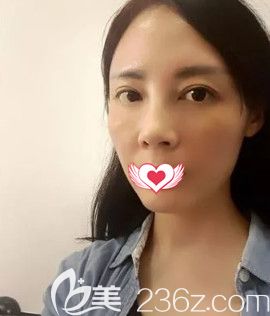 巧致院长王立英做脂肪填充面部7天面部消肿 巧致院长王立英做脂肪填充面部7天面部消肿