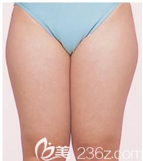 元神贤太给我做大腿吸脂前 元神贤太给我做大腿吸脂前