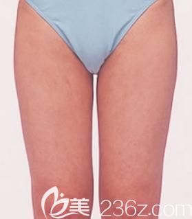 在日本东京青山赛俪丝医院找元神贤太给我做了大腿吸脂，摆脱大象腿