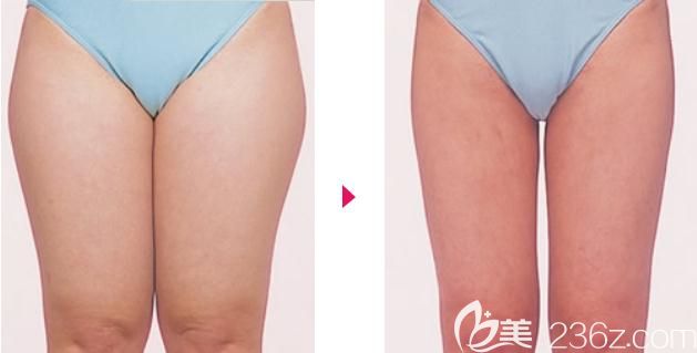 元神贤太给我做大腿吸脂前后对比 元神贤太给我做大腿吸脂前后对比