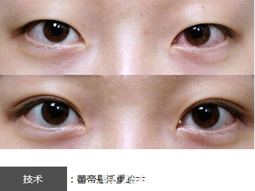 宜昌蕾帝整形医院悬浮重睑术双眼皮效果图