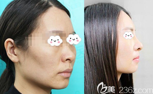 宜昌蕾帝整形医院鼻综合隆鼻案例效果对比图