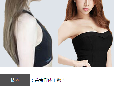 宜昌蕾帝整形医院假体隆胸案例效果对比图