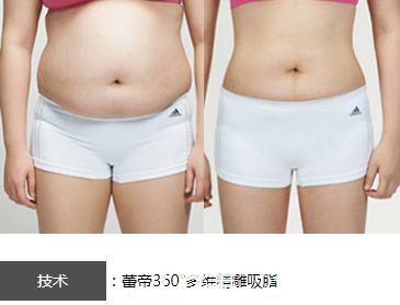 宜昌蕾帝整形医院360°多维精雕吸脂效果对比图