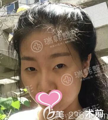 自体脂肪填充面部+萝莉大眼术前照 自体脂肪填充面部+萝莉大眼术前照