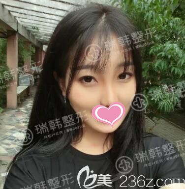 做自体脂肪填充面部+萝莉大眼术后1个月效果 做自体脂肪填充面部+萝莉大眼术后1个月效果