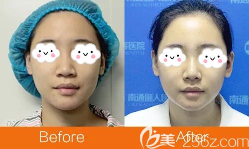 南通俪人连天美做假体隆鼻真人案例 南通俪人连天美做假体隆鼻真人案例